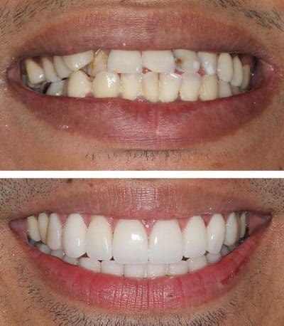 Before and after dental veneers