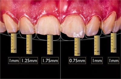 Dental Veneer options with different measurements 