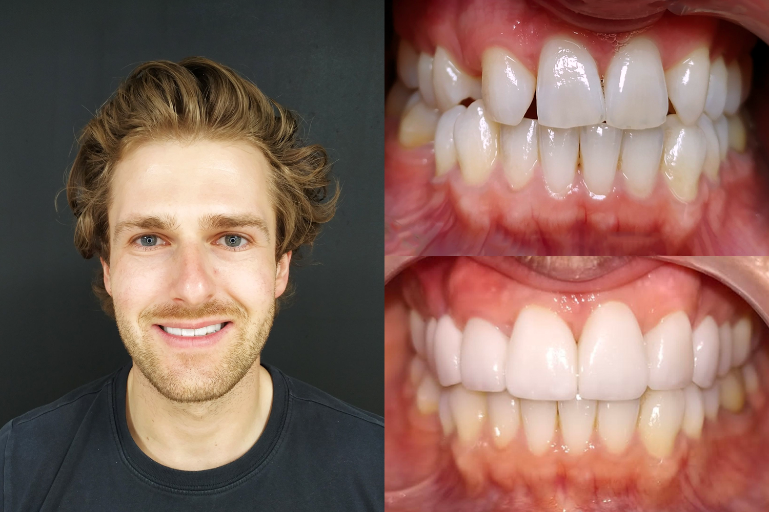 Dental Veneers in Tijuana, Mexico Save 4070 Now Allo Dental